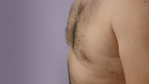 Gynecomastia - after 6 months